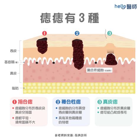 痣種類|痣形成的原因？痣長毛、痣變多變大是痣病變？5招判。